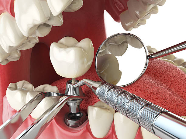 Best Emergency Tooth Extraction in Garnett, KS